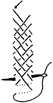 Mammen stitch